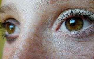 ojo seco tratamiento natural