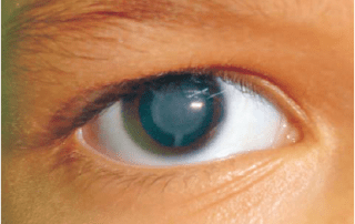 Todo sobre la operación de cataratas