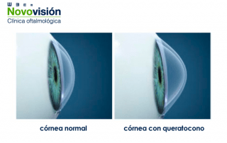 queratocono