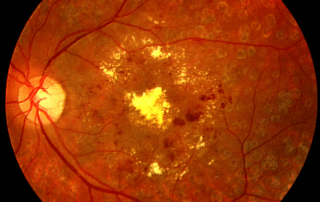 retinopatia