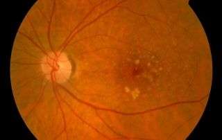 DMAE - Degeneración Macular Asociada a la Edad