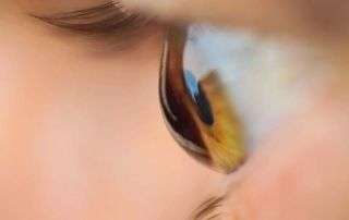 queratocono-Novovisión