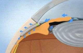 Miniject cirugía microinvasiva del glaucoma - Novovisión