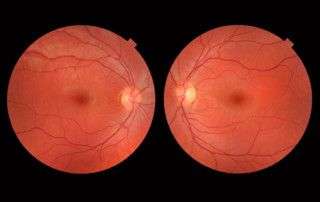 retinografía como metodo diagnostico frente a determinadas patologias