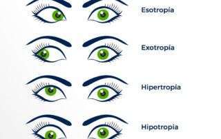 que-es-la-foria-ocular