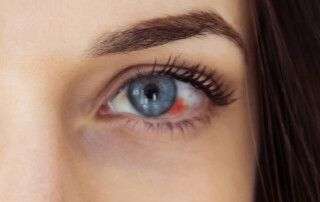 Hiposfagma - Guía completa