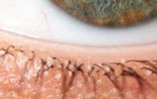 Microexfoliación Palpebral