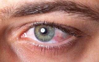 Conjuntivitis virica