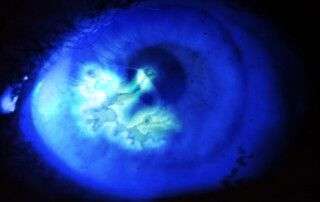 queratitis herpética