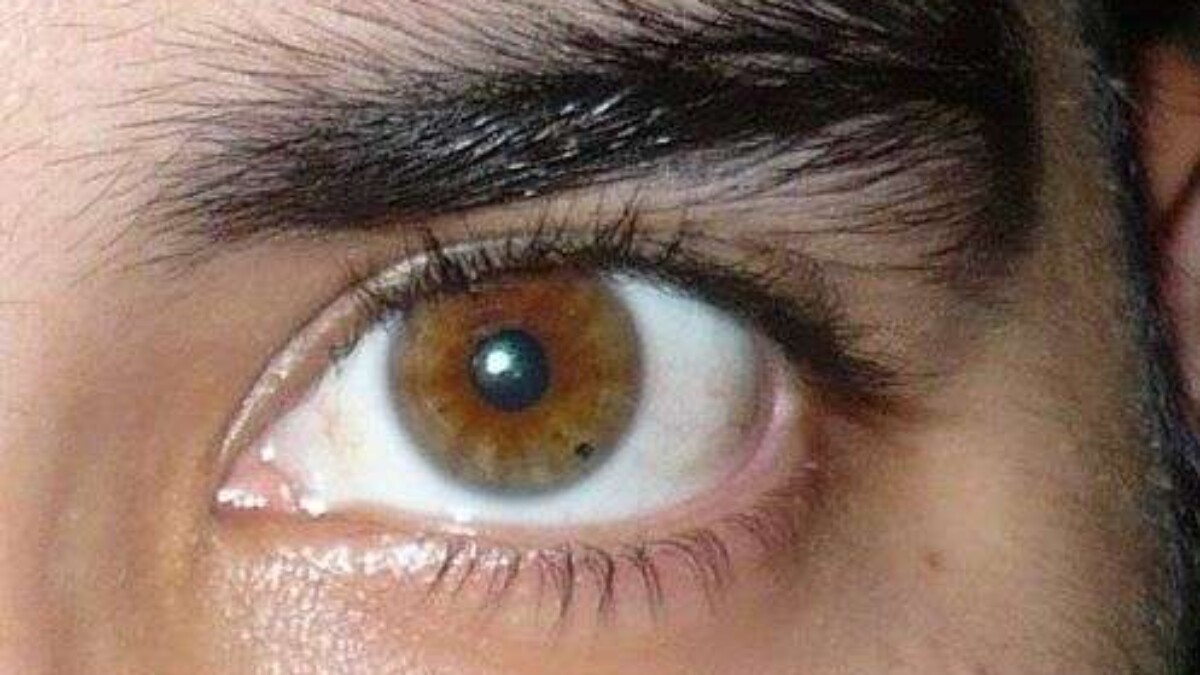 mancha melanotica ¿Qué es la melanosis conjuntival?