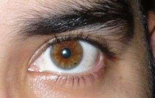 melanosis conjuntival