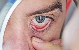 Tratamiento ojo seco con luz pulsada IPL