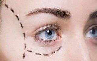Blefaroplastia