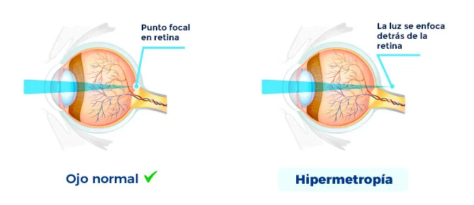 cirugia refractiva operacion hipermetropia muestra