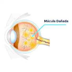 DMAE Degeneración Macular Asociada a la Edad
