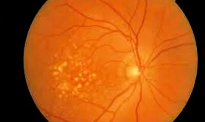 Degeneración macular asociada a la edad.